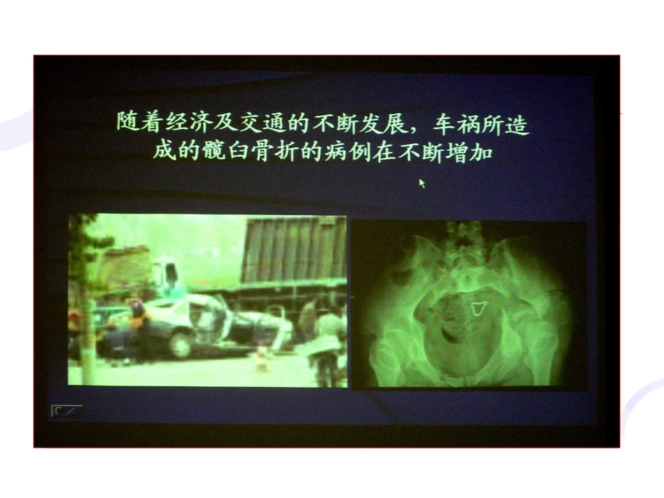 髋臼 骨折_第4页