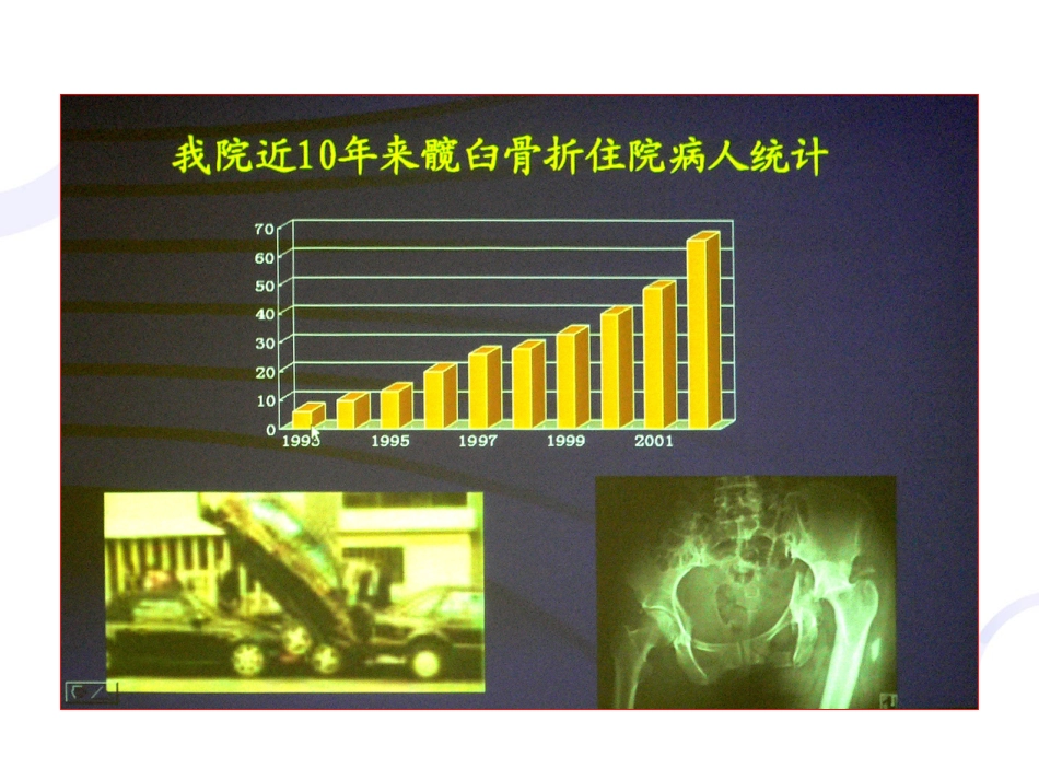 髋臼 骨折_第5页