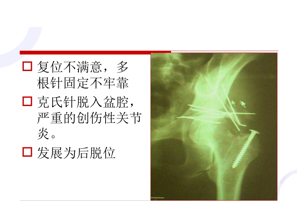 髋臼 骨折_第9页