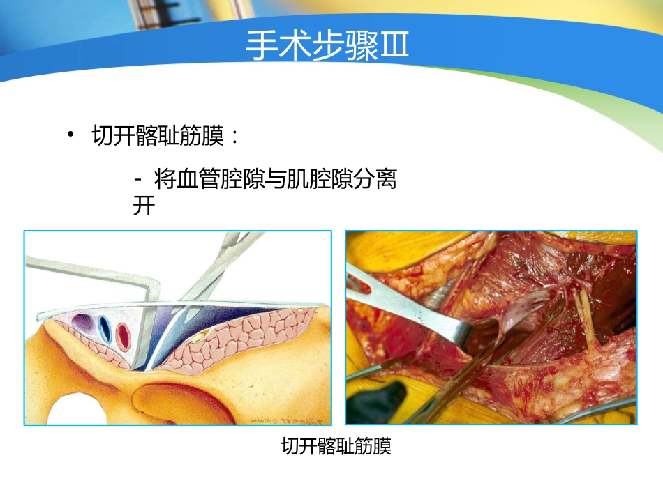 骨盆髋臼 入路选择_第11页