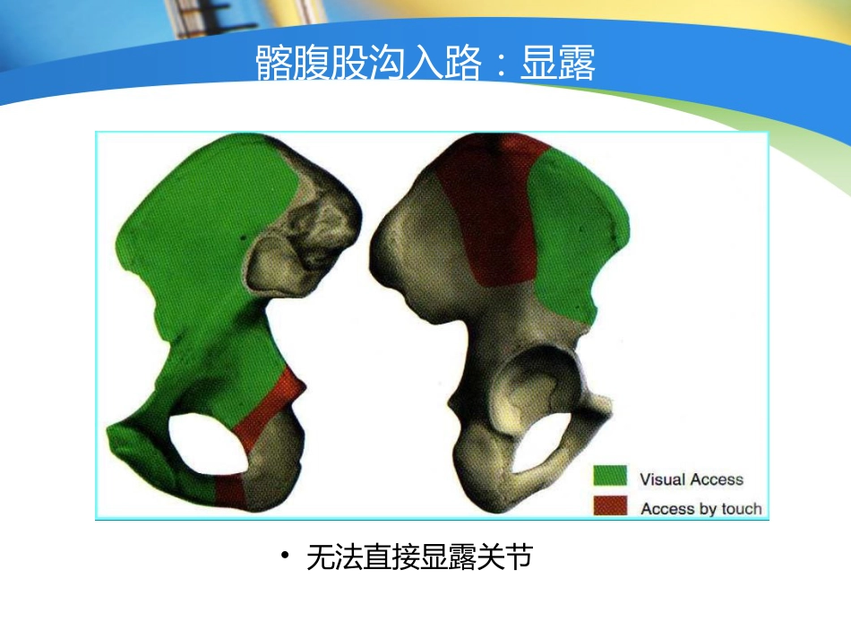 骨盆髋臼 入路选择_第6页