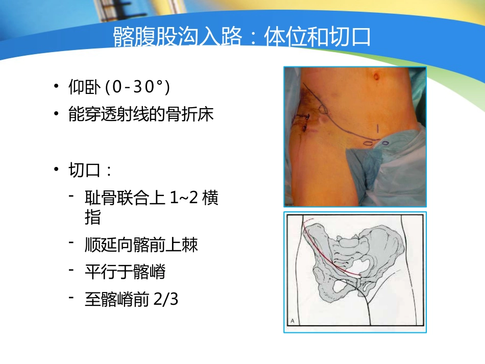 骨盆髋臼 入路选择_第8页