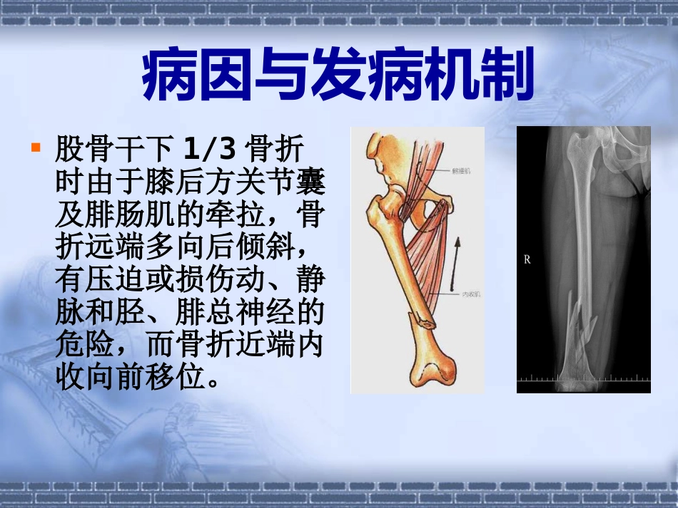 股骨干 骨折_第10页