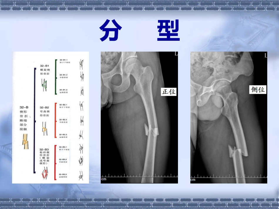 股骨干 骨折_第14页