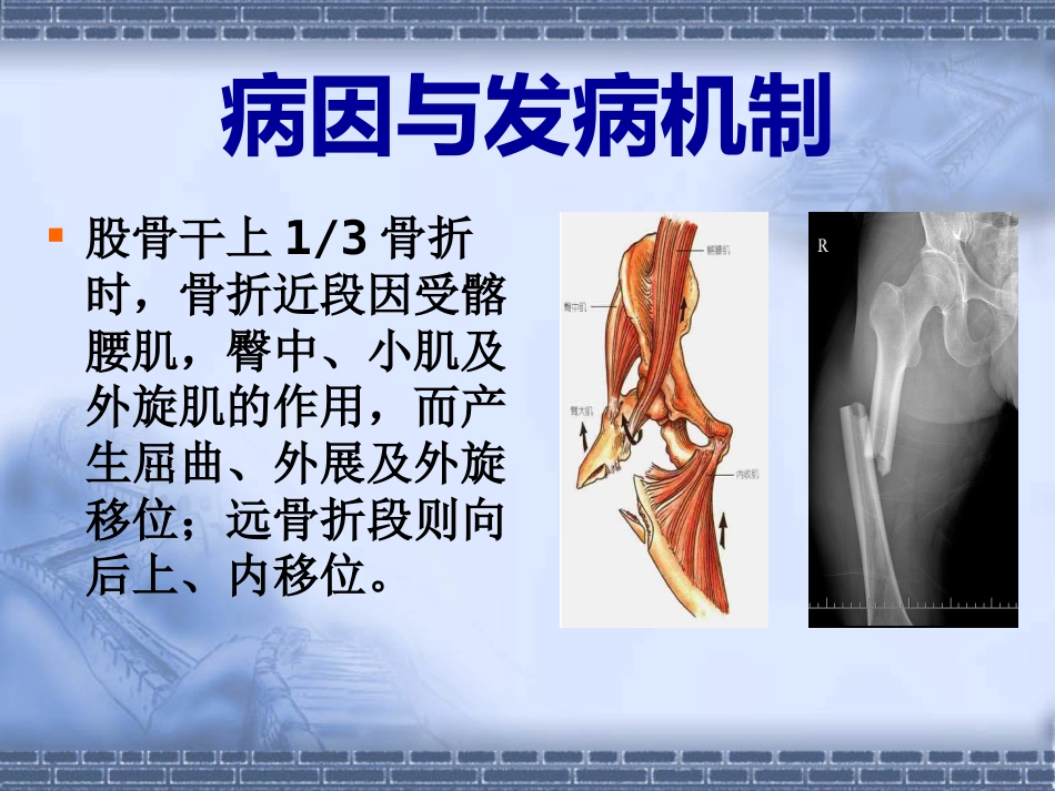 股骨干 骨折_第8页