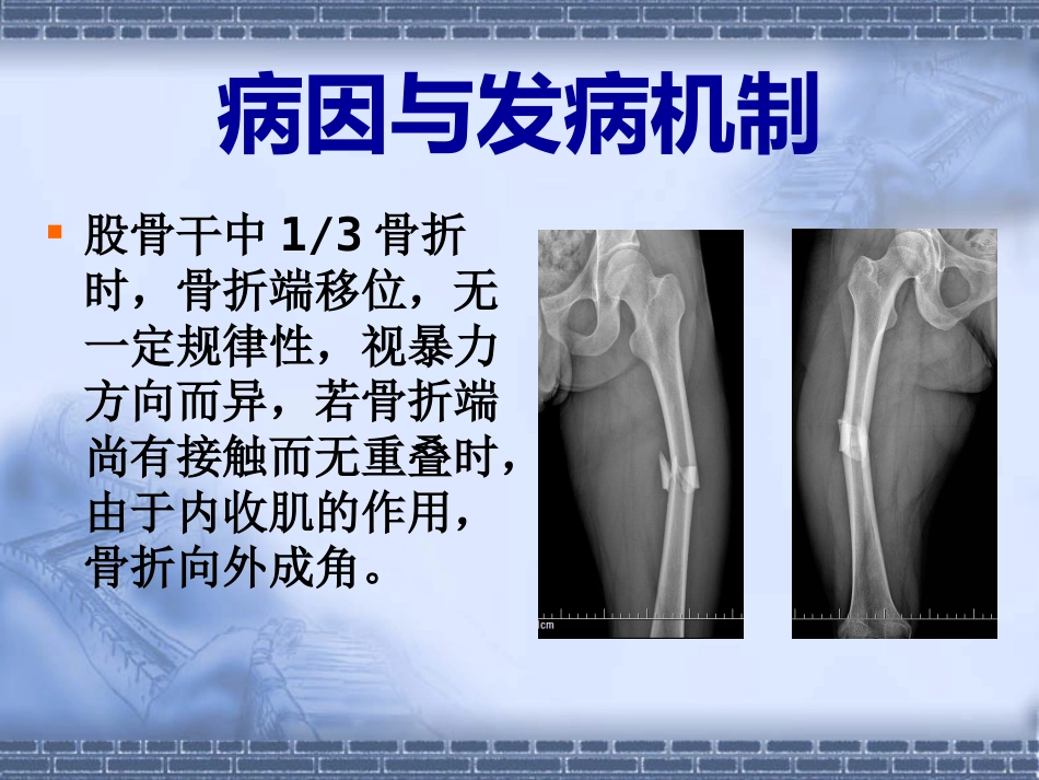 股骨干 骨折_第9页