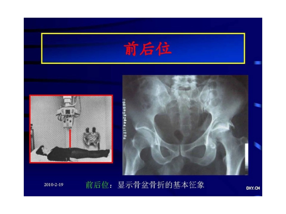 骨盆 与髋臼骨折的诊断与分型_第7页