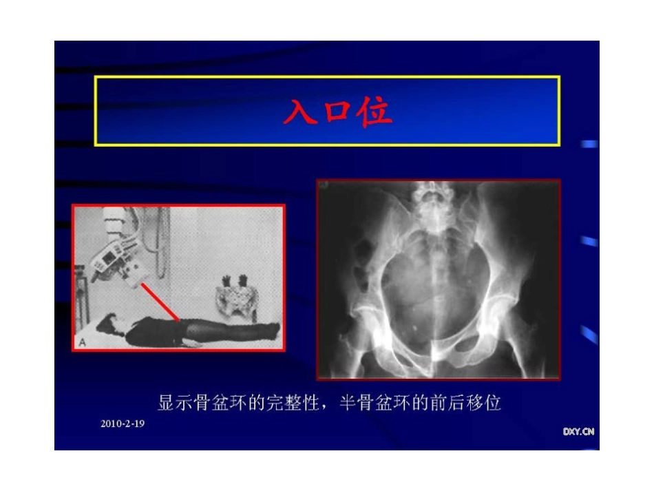 骨盆 与髋臼骨折的诊断与分型_第8页