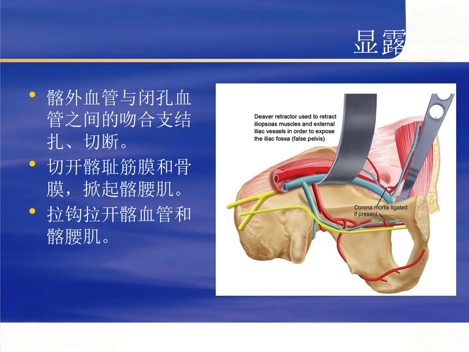 改良Stoppa 入路在骨盆髋臼骨折中的应用_第15页