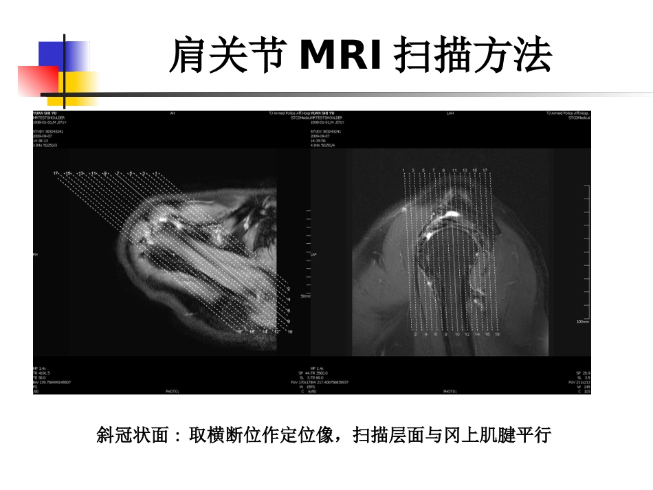 肩关节病变 MRI解剖和诊断_第10页