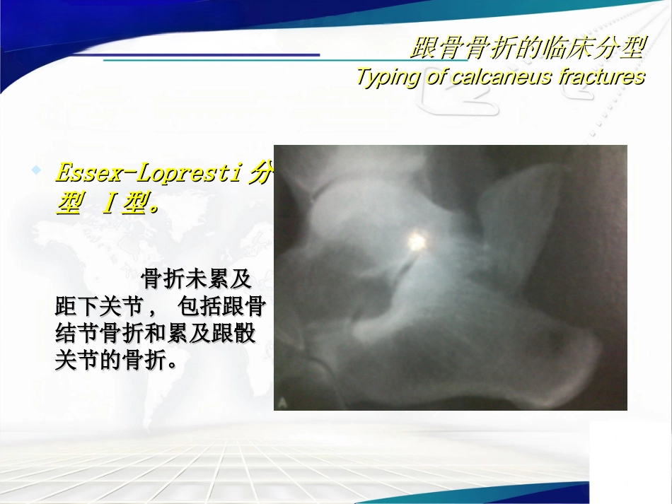 跟骨骨折 的分型与治疗讲座_第10页