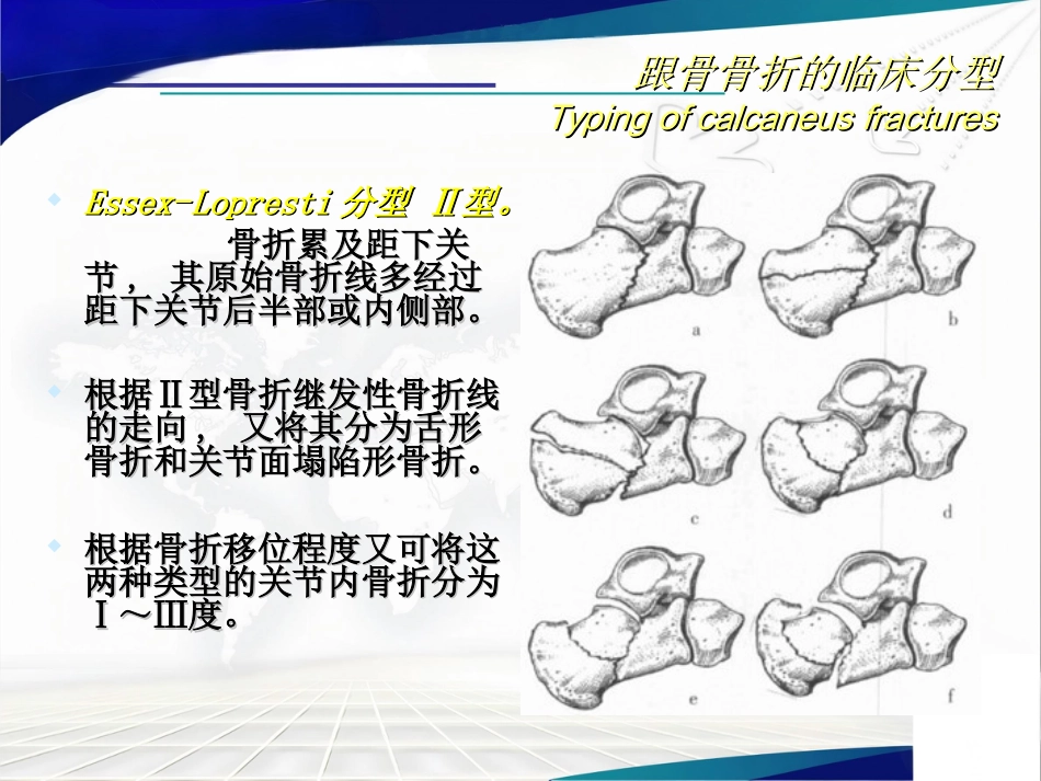 跟骨骨折 的分型与治疗讲座_第11页