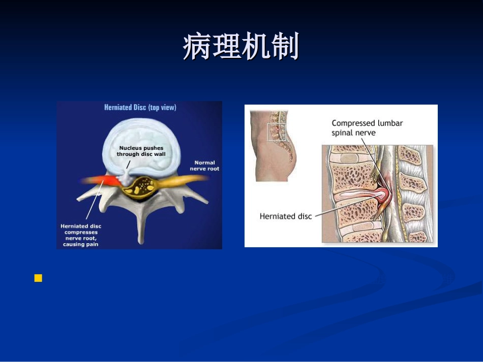 五年制讲稿——腰腿痛和颈肩痛_第14页