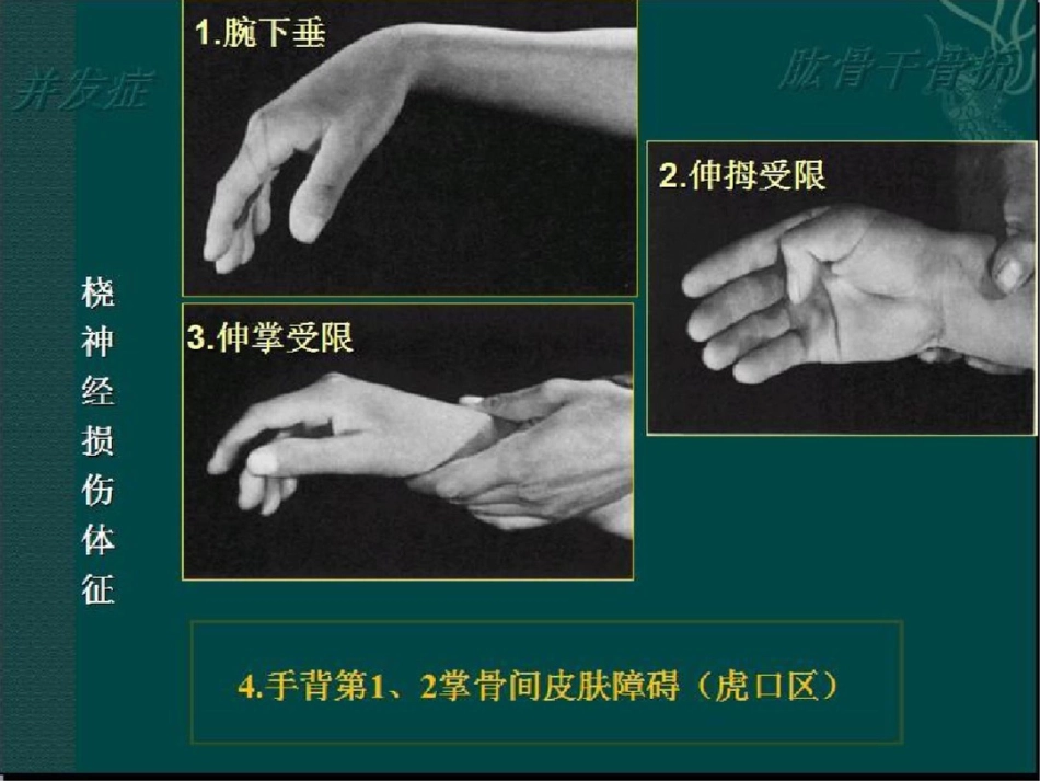 肱骨干骨折 讲解_第13页
