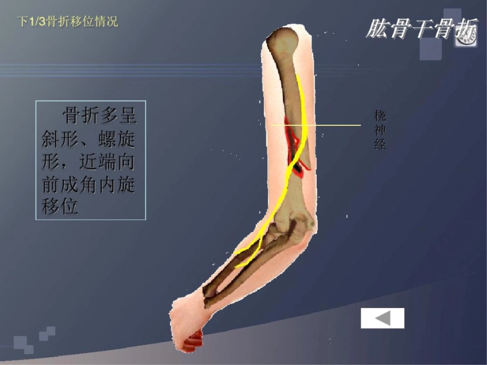 肱骨干骨折 讲解_第4页