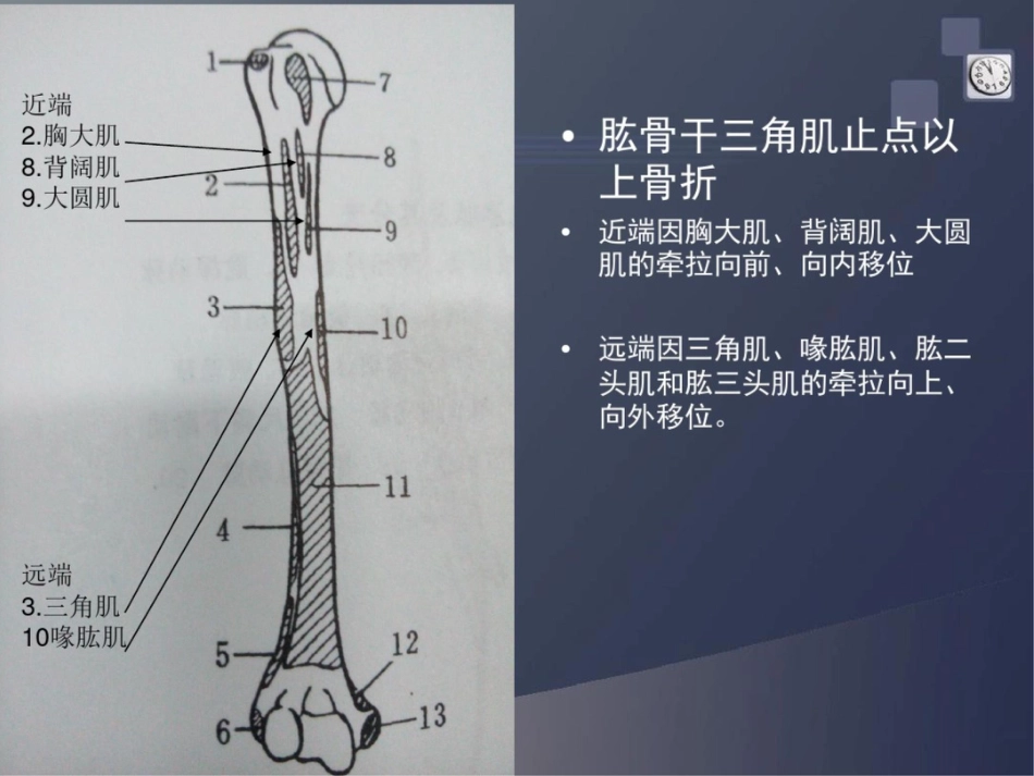 肱骨干骨折 讲解_第6页