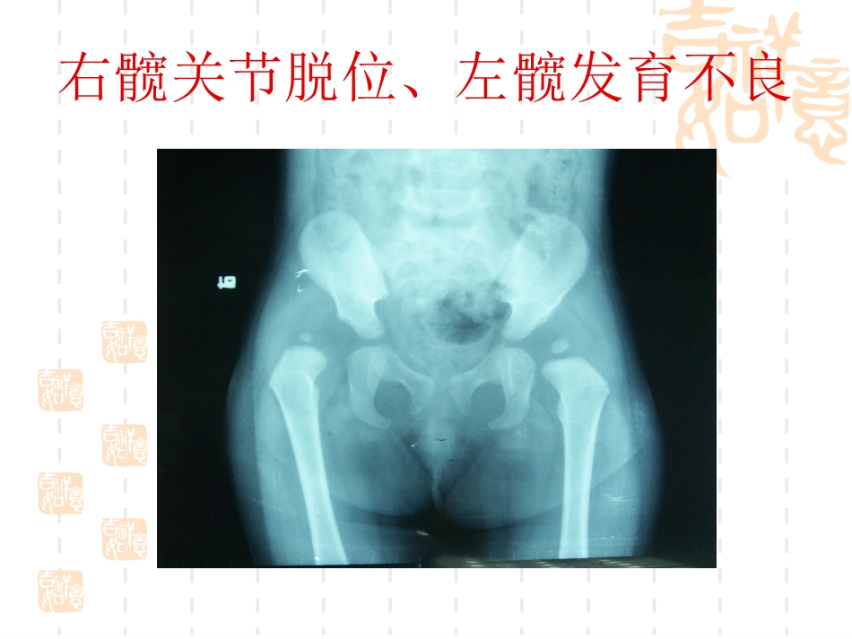 发育性 髋关节脱位_第10页