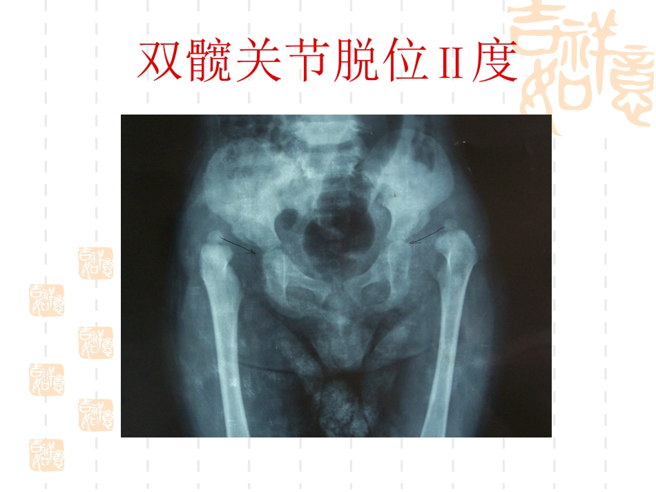 发育性 髋关节脱位_第12页