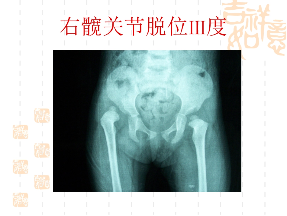 发育性 髋关节脱位_第13页