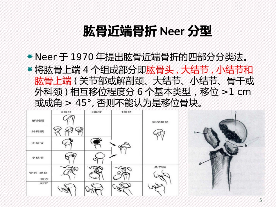 肱骨近端骨折 分型及治疗_第5页