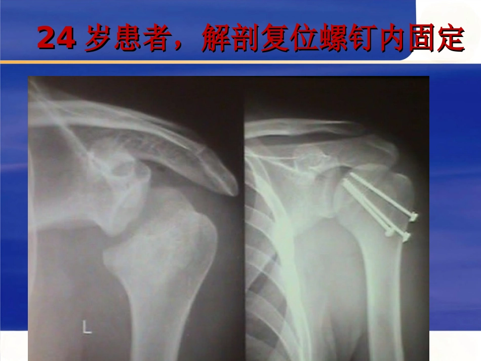 肱骨近端骨折 Neer分型及治疗_第14页