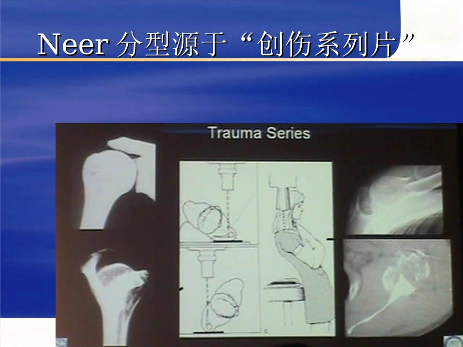 肱骨近端骨折 Neer分型及治疗_第5页