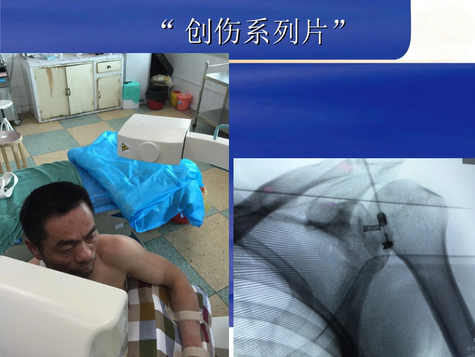 肱骨近端骨折 Neer分型及治疗_第6页