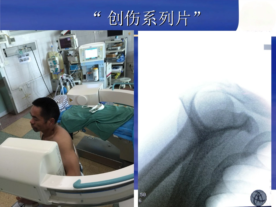 肱骨近端骨折 Neer分型及治疗_第7页