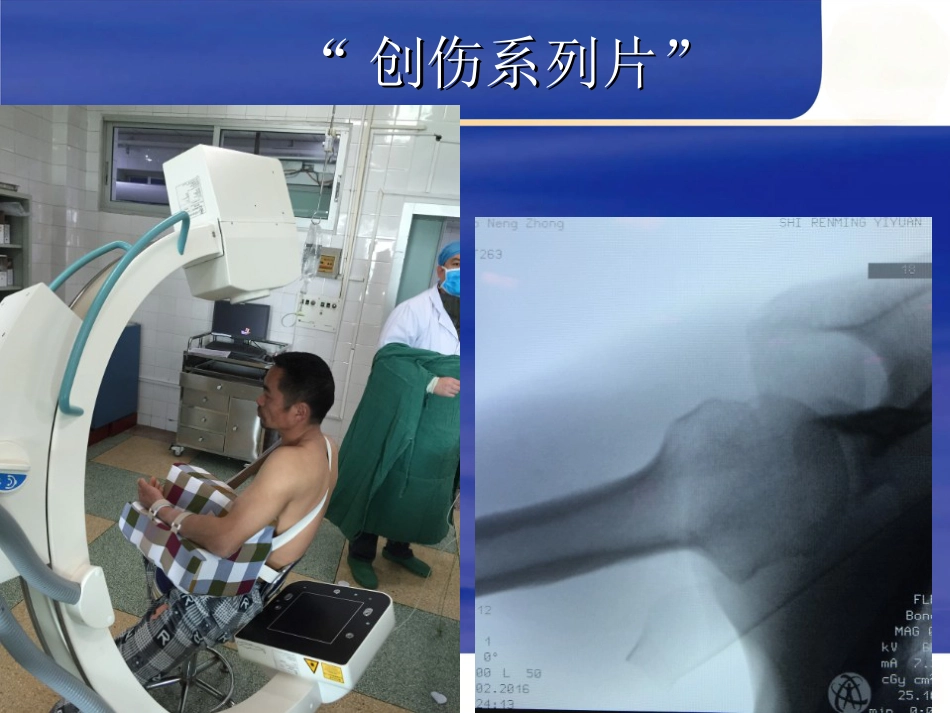 肱骨近端骨折 Neer分型及治疗_第8页