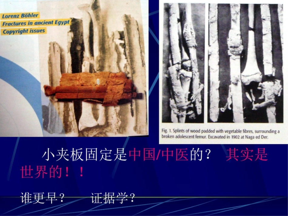 肱骨干骨折 保守治疗的技巧与陷阱_第5页