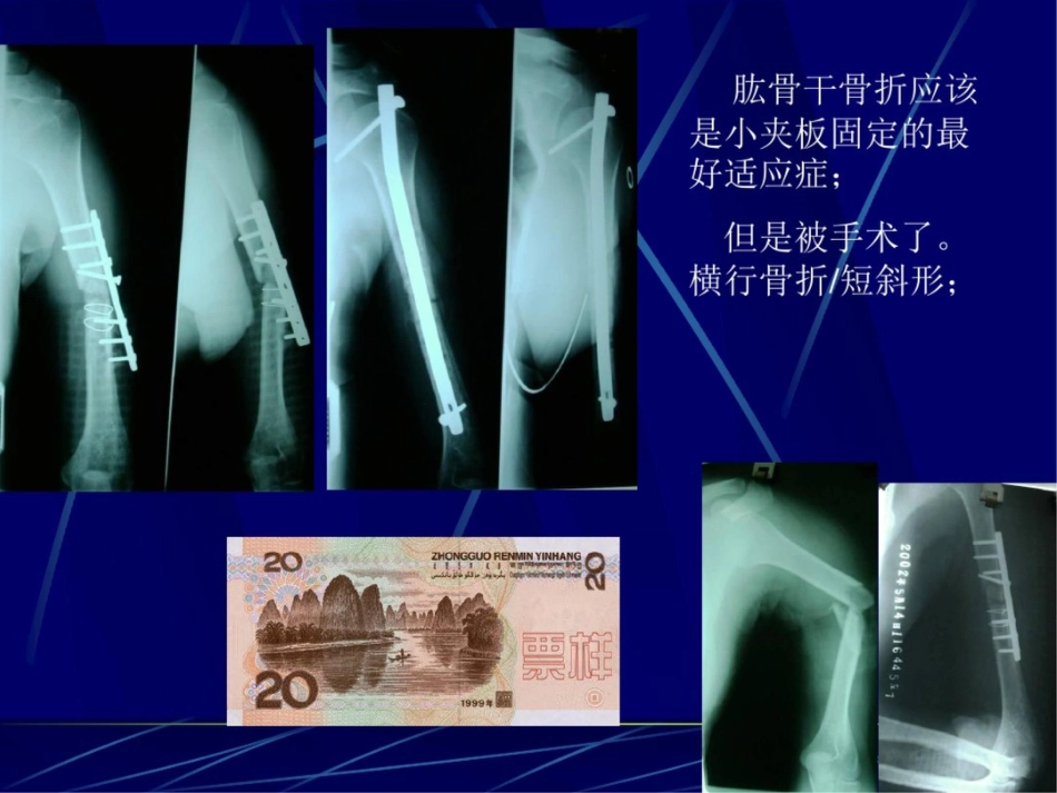 肱骨干骨折 保守治疗的技巧与陷阱_第9页