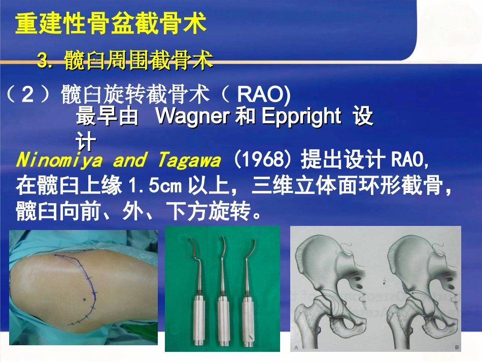成人髋关节 发育不良的手术选择_第13页