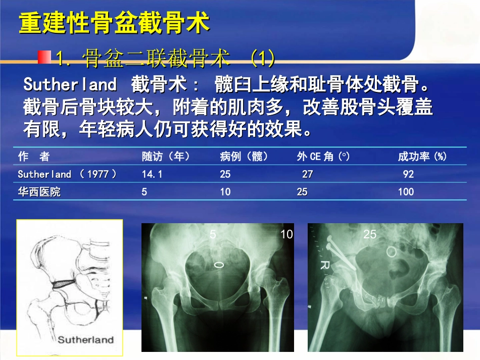 成人髋关节 发育不良的手术选择_第5页