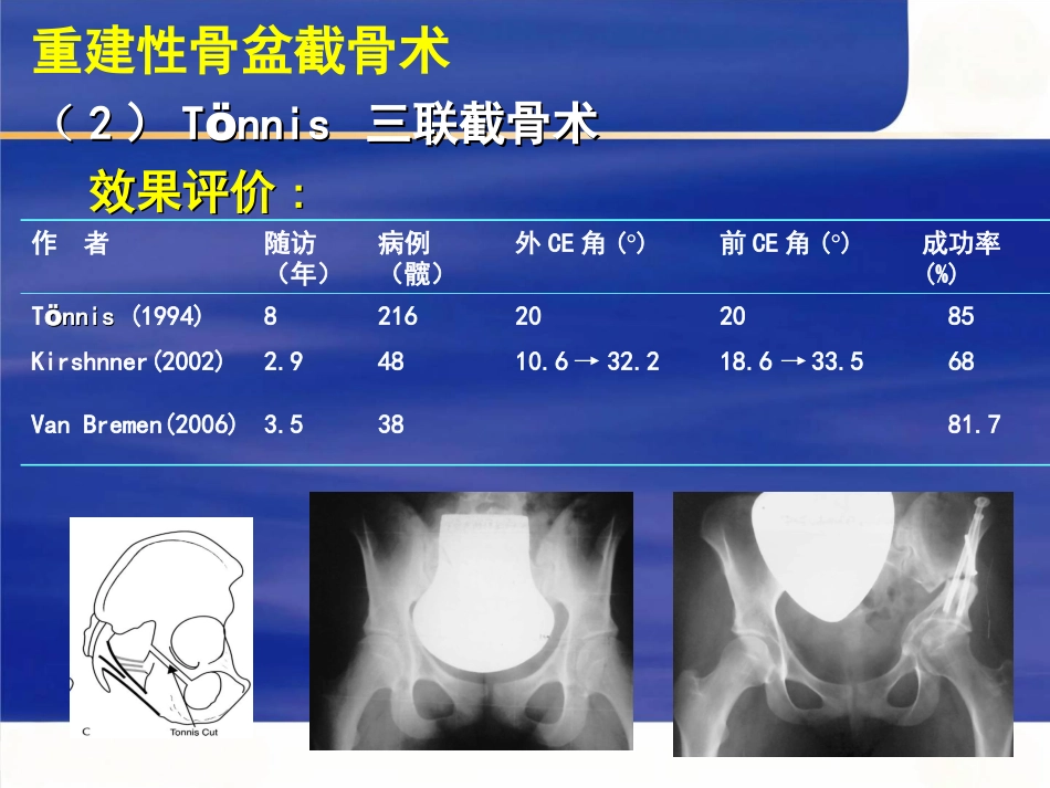 成人髋关节 发育不良的手术选择_第8页