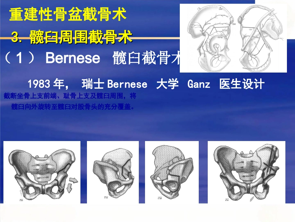 成人髋关节 发育不良的手术选择_第9页