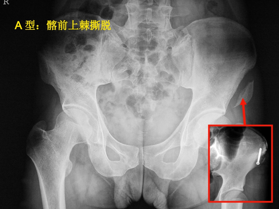 骨盆骨折 急诊处理的一般原则_第12页