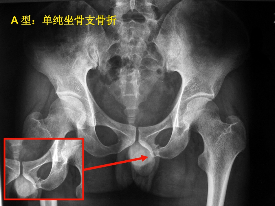 骨盆骨折 急诊处理的一般原则_第13页