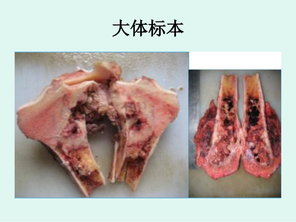 骨肉瘤 的影像学诊断_第8页