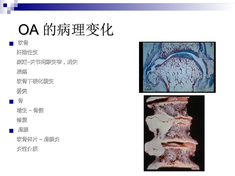 骨关节炎 治疗_第14页