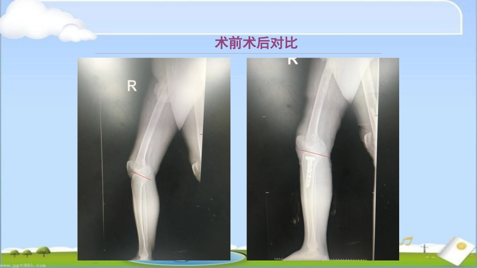 HTO 治疗前交叉韧带损伤伴屈曲挛缩畸形_第11页