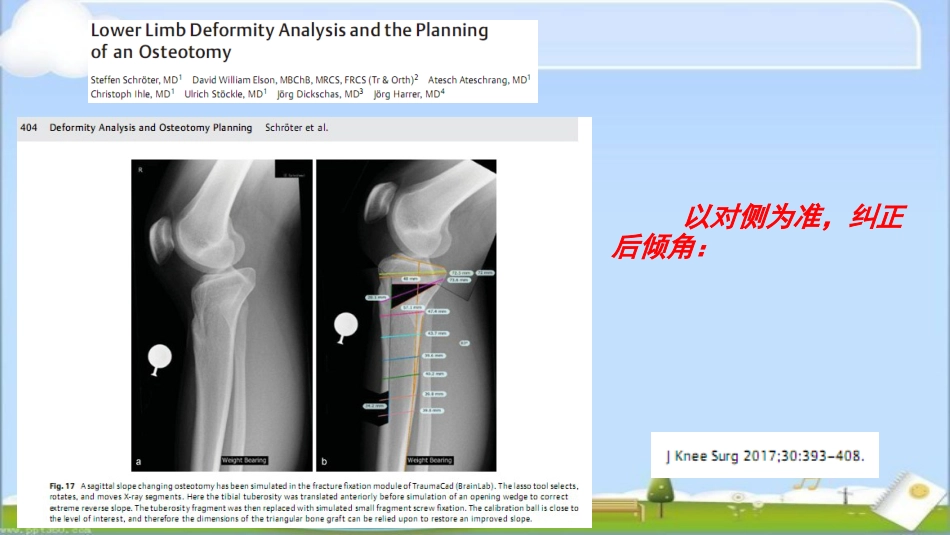HTO 治疗前交叉韧带损伤伴屈曲挛缩畸形_第15页