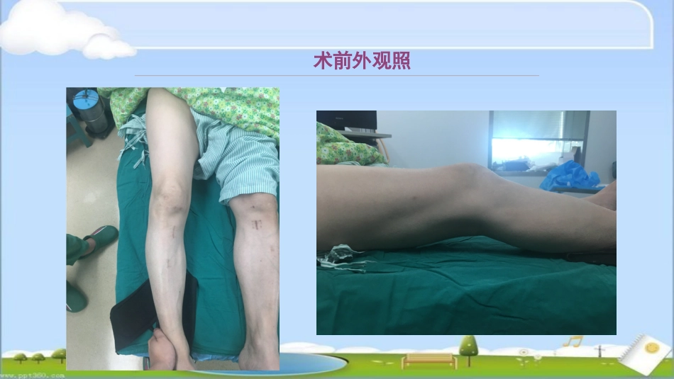HTO 治疗前交叉韧带损伤伴屈曲挛缩畸形_第3页