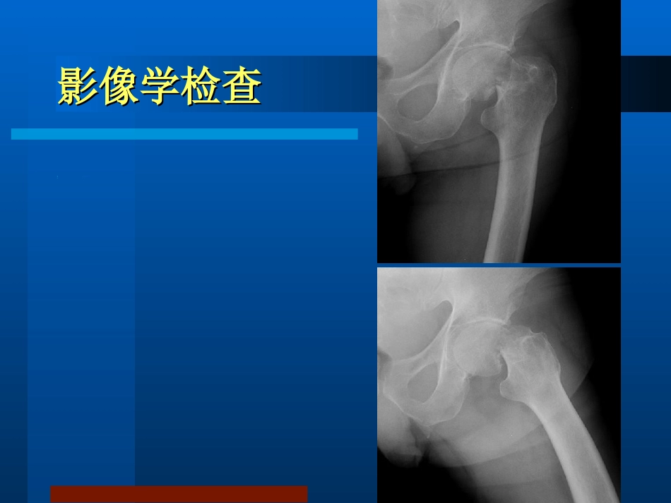 股骨颈骨折 治疗选择_第10页