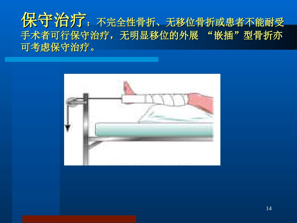 股骨颈骨折 治疗选择_第14页