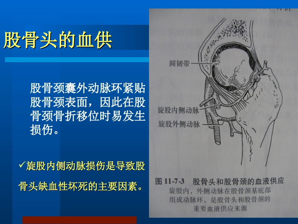 股骨颈骨折 治疗选择_第4页