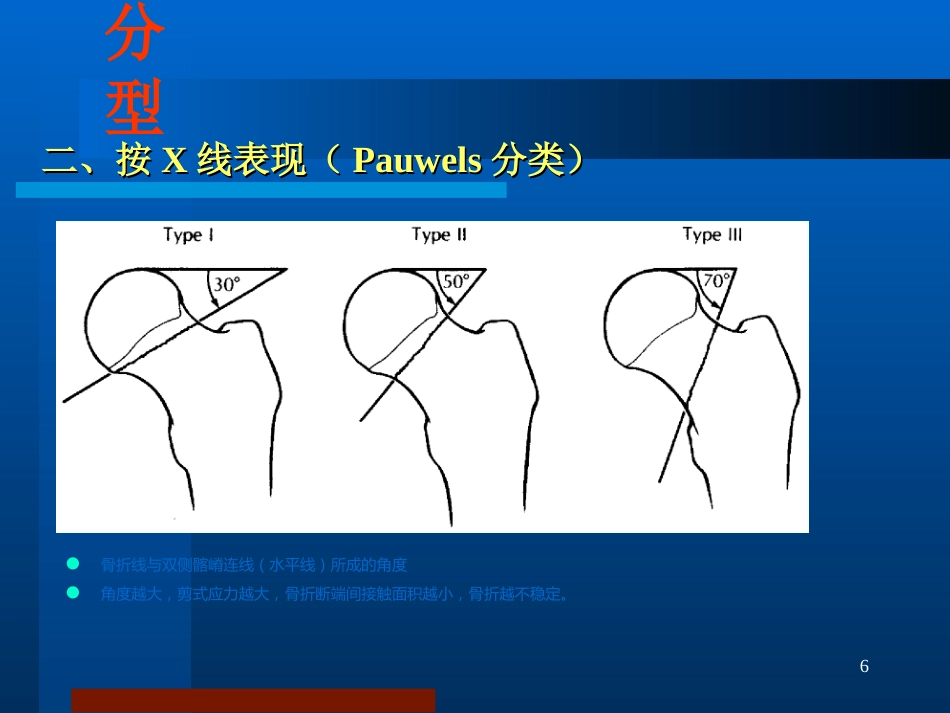 股骨颈骨折 治疗选择_第6页