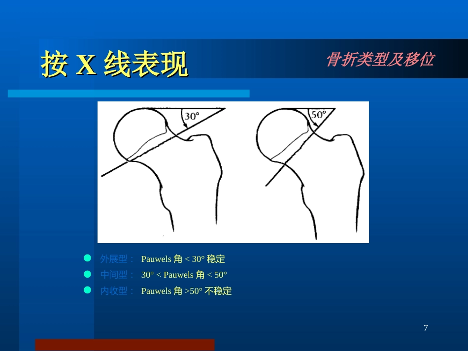 股骨颈骨折 治疗选择_第7页