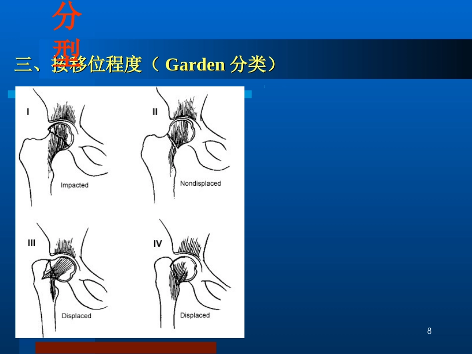 股骨颈骨折 治疗选择_第8页