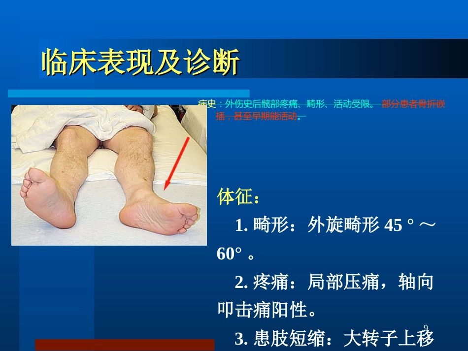 股骨颈骨折 治疗选择_第9页