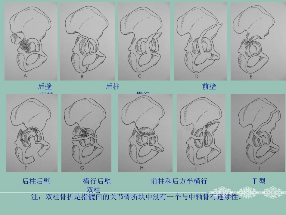 骨盆 髋臼骨折的分型_第14页